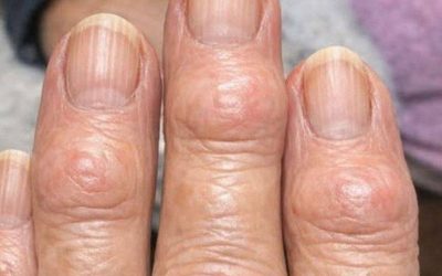Meine Großmutter hat harte Beulen an den Fingergelenken, nahe den Nägeln. Warum breitet sich das aus? (Vollständiger Artikel)👇 💬