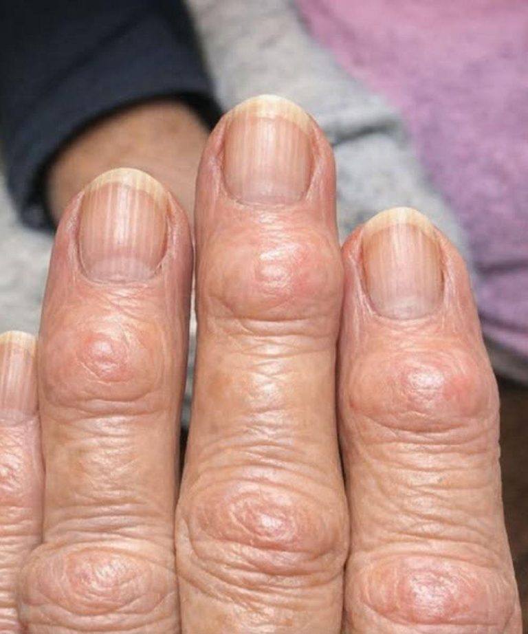 Meine Großmutter hat harte Beulen an den Fingergelenken, nahe den Nägeln. Warum breitet sich das aus? (Vollständiger Artikel)👇 💬