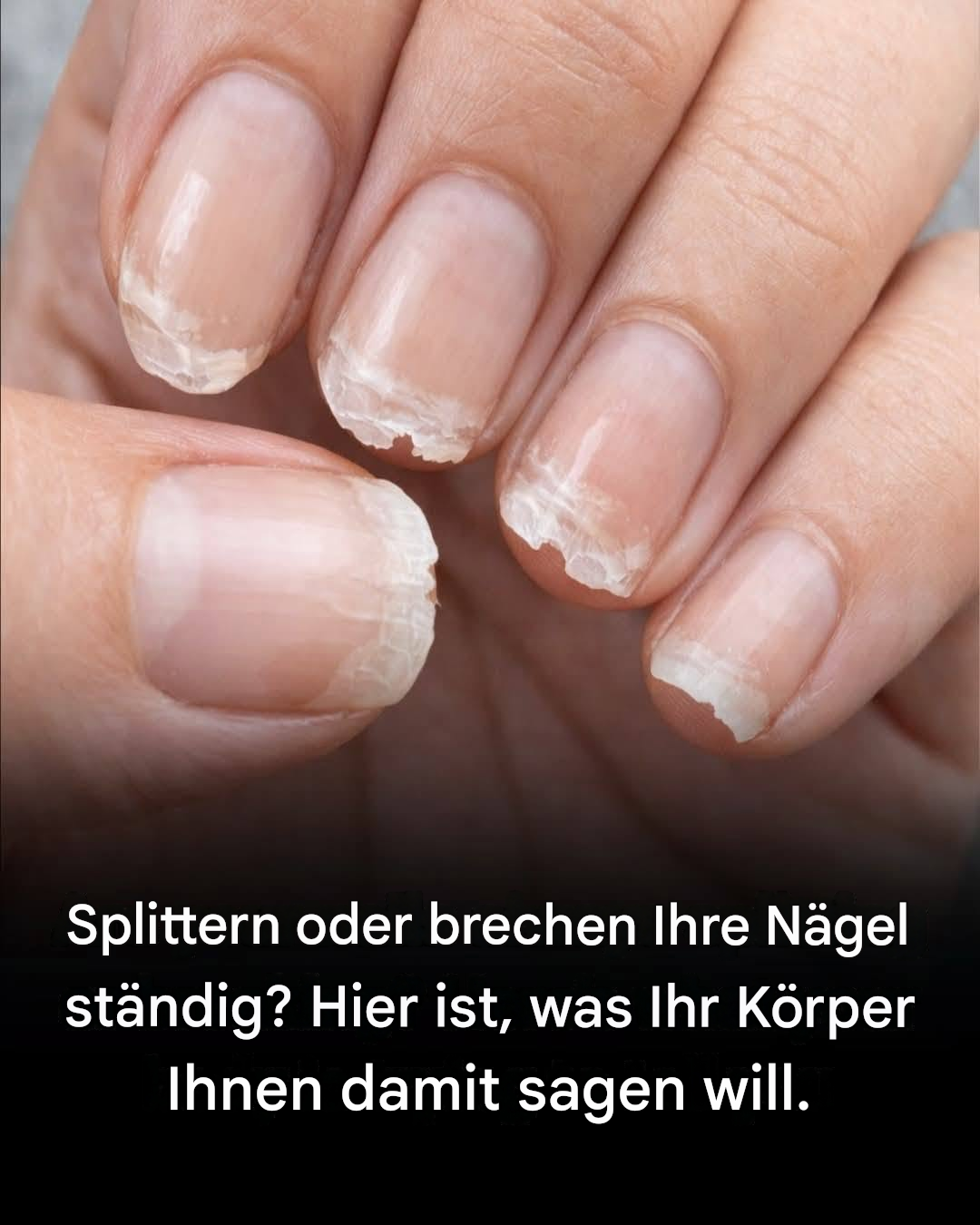 Brüchige oder brüchige Nägel: Was Ihr Körper Ihnen damit sagen will