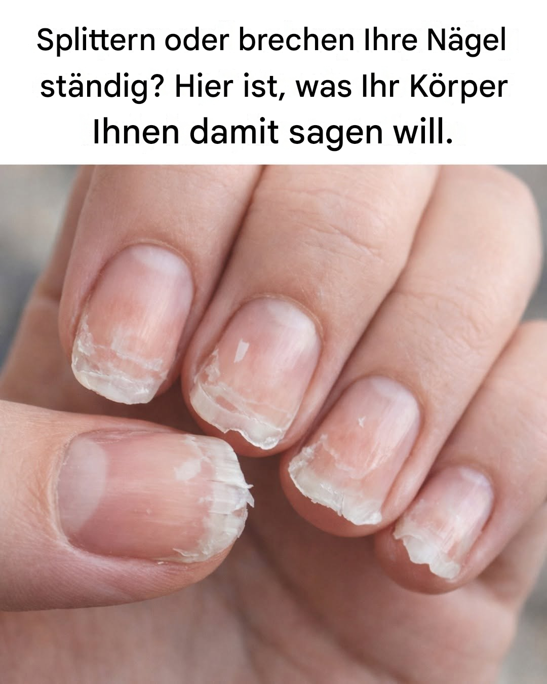 Was schwache oder brüchige Nägel über Ihre Gesundheit aussagen könnten