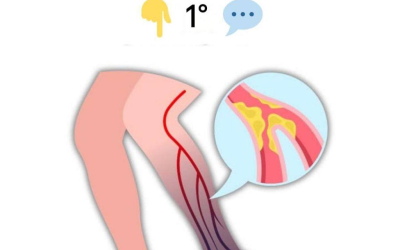 10 Segnali di avvertimento di a sanguelo di sangue nella gamba che dovresti conoscere